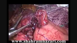 مینی گاستریک بای پاس معده بدنبال اسلیو گاسترکتومی شکست خورده