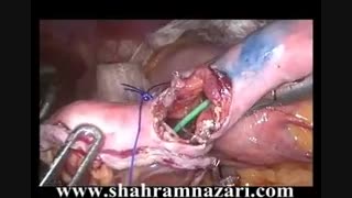 مینی گاستریک بای پاس در درمان چاقی مرضی