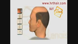 کلیپ انیمیشن پیوند مو و کاشت مو SUT