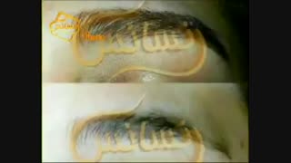 کاشت ابرو طبیعی با روش SUT مرکز کاشت مو ترمیم سوختگی