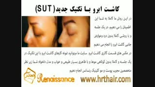 کاشت ابرو طبیعی با روش SUT مرکز کاشت مو کلینیک لیزر