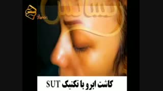 کاشت ابرو طبیعی با روش SUT مرکز کاشت مو جراحی فک