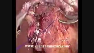 فوندوپلیکاسیون لاپاروسکوپیک توپه توسط دکتر شهرام نظری کربوکسی تراپی