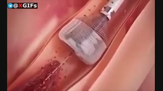 انژوگرافی رگ های قلب