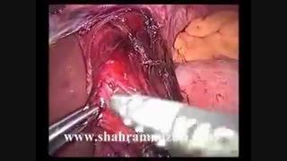 جراحی آشالازی