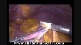 Sleeve Gastrectomy اسلیو گاسترکتئمی توسط دکتر شهرام نظری کلینیک دندانپزشکی