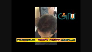 ترمیم مو گلهای تهران - کاشت مو - روش های فیکس آلمان