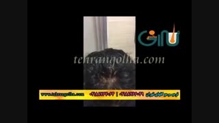 ترمیم مو گلهای تهران - کاشت مو - روش های فیکس آلمان