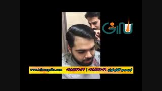 ترمیم مو گلهای تهران - کاشت مو - روش های فیکس آلمان