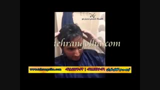 ترمیم مو کاشت مو روش ترمیم مو