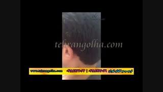 ترمیم مو گلهای تهران - کاشت مو - روش های فیکس آلمان