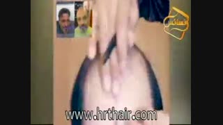 ترمیم مو به روش HRT  مرکز تخصصی مو رنسانس