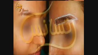 کاشت ابرو طبیعی با روش SUT مرکز کاشت مو