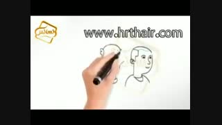 کلیپ انیمیشن پیوند مو و کاشت مو به روش SUT