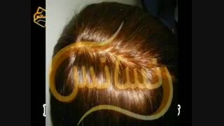 ترمیم مو به روش HRT  مرکز تخصصی مو رنسانس