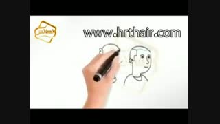 کلیپ انیمیشن پیوند مو و کاشت مو به روش SUT