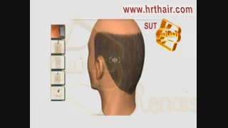 کلیپ انیمیشن پیوند مو و کاشت مو به روش SUT