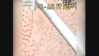 کلیپ انیمیشن پیوند مو و کاشت مو به روش SUT