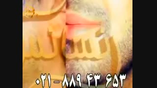 کاشت ریش و سبیل به روش SUT مرکز تخصصی موی رنسانس