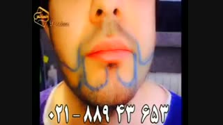 کاشت ریش و سبیل به روش SUT مرکز تخصصی موی رنسانس