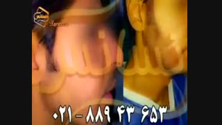 کاشت ریش و سبیل به روش SUT مرکز تخصصی موی رنسانس