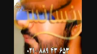 کاشت ریش و سبیل به روش SUT مرکز تخصصی موی رنسانس