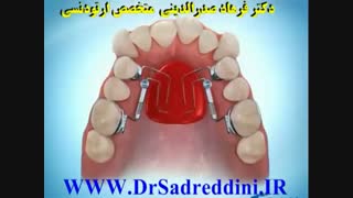 ارتودنسی عمل زیبایی