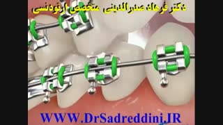 ارتودنسی لیفت گردنایمپلنت دندان