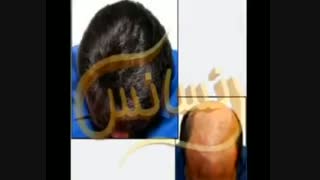 ترمیم مو به روش HRT  مرکز تخصصی مو رنسانس