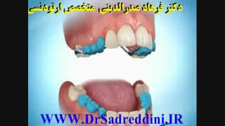 ارتودنسی آر اف فرکشنال