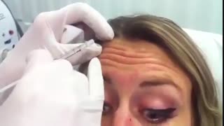 تزریق بوتاکس