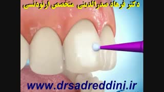 ارتودنسی لیزر صورت