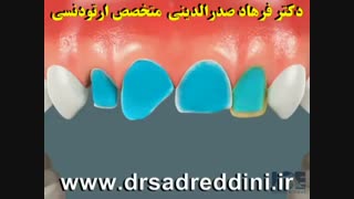 ارتودنسی رفع غبغب