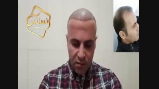 کاشت مو به روش SUT مرکز مو رنسانس