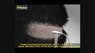 کاشت مو  و معرفی کلی از آن با سایت iranhair.net