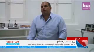 پیوند دست بدون انگشت به شکم!