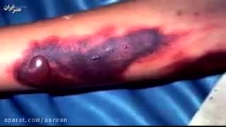 دانستنی های مهم دربارە بیماری مرگبار تب کریمە