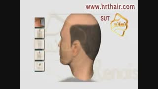انیمیشن پیوند مو و کاشت مو به روش SUT