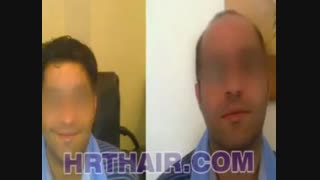 ترمیم مو به روش HRT  مرکز تخصصی مو رنسانس