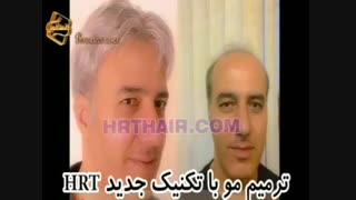 ترمیم مو به روش HRT  مرکز تخصصی مو رنسانس