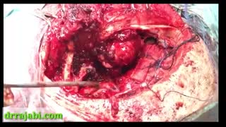 جراحی تومور بزرگ در کاسه چشم