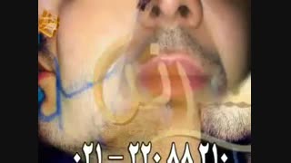 کاشت ریش و سبیل به روش SUT مرکز مو رنسانس