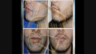 کاشت ریش و سبیل به روش SUT مرکز مو رنسانس