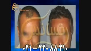کاشت مو به روش SUT مرکز مو رنسانس