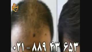 کاشت مو به روش SUT مرکز مو رنسانس