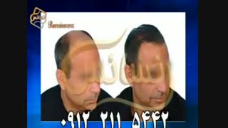 کاشت مو به روش SUT مرکز مو رنسانس