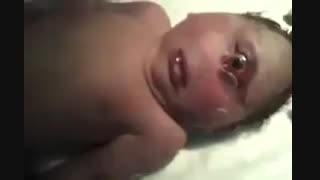 نوزاد عجیب الخلقه با یک چشم