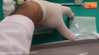 بندینگ ارتودنسی | دکتر مسعود داوودیان پیلینگ شیمیایی