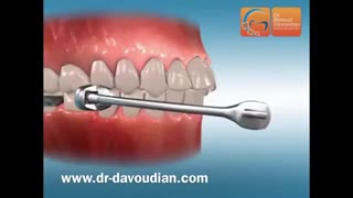 دیستالیزور کریر | دکتر مسعود داودیان برداشتن خال