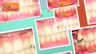 ارتودنسی با سیستم دیمون | دکتر مسعود داوودیان دندان شیری